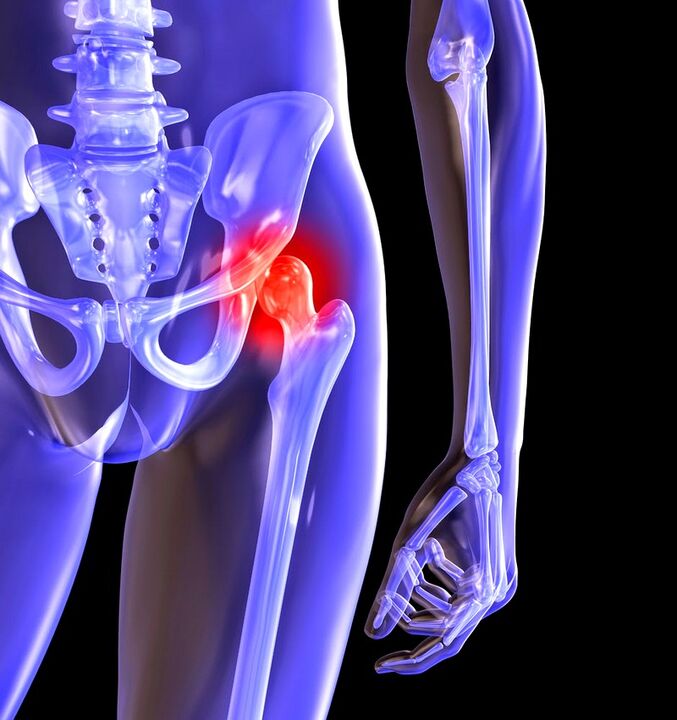 Déformation de l'arthrose de l'articulation de la hanche