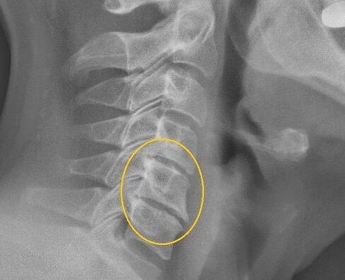 Ostéochondrose de la colonne cervicale dans une ligne X