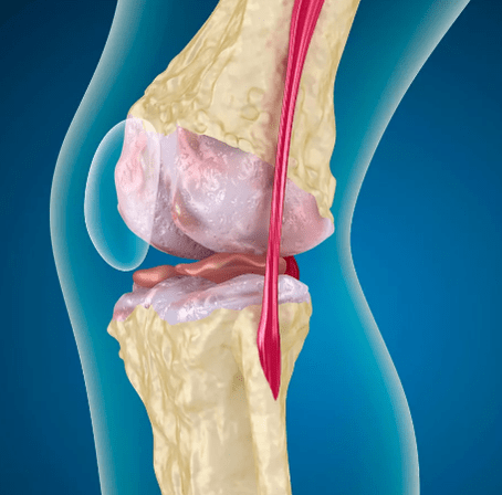 Arthrose articulaire du genou