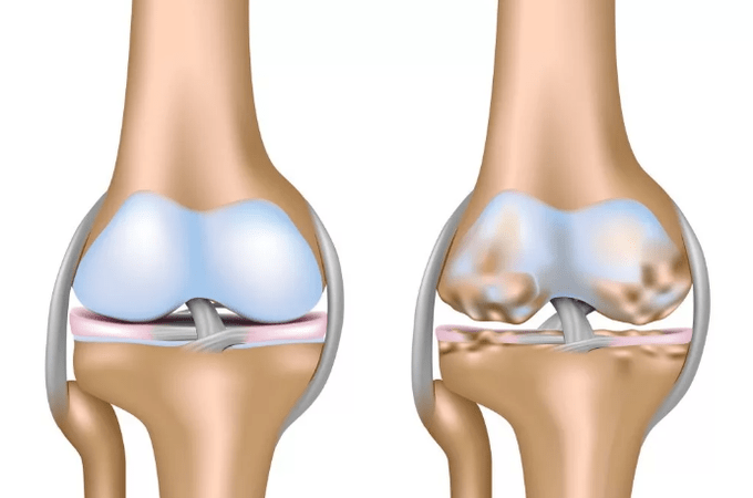 Déformation de l'arthrose de l'articulation du genou