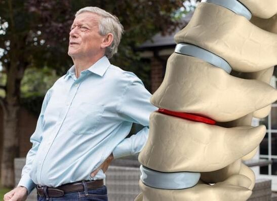 L'ostéochondrose affecte les disques intervertébraux et provoque des maux de dos.